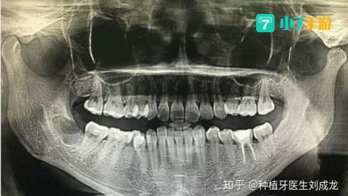 河南拔智齿